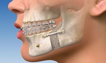 5 Questions You Need To Ask Your Orthodontist About Dental Implants